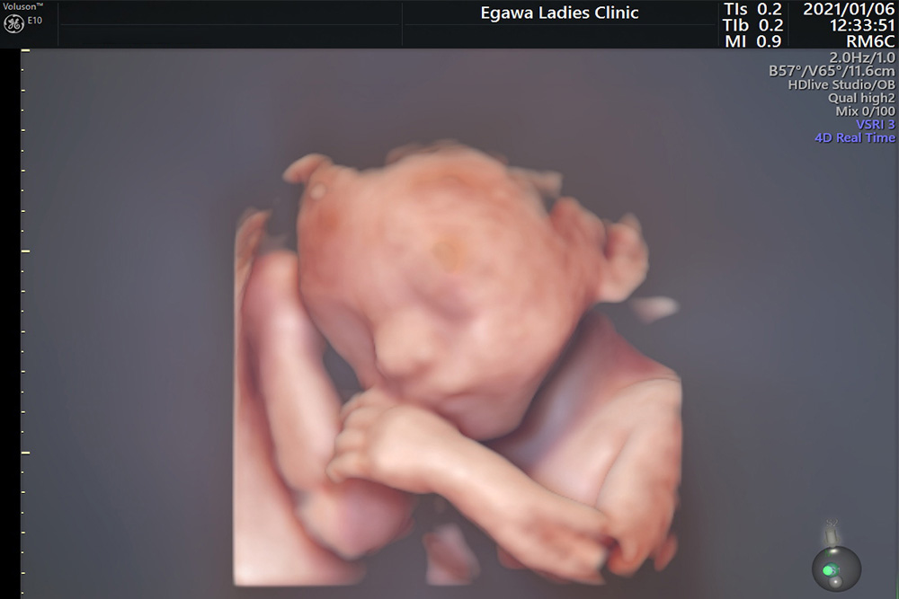 胎児超音波スクリーニング検査
