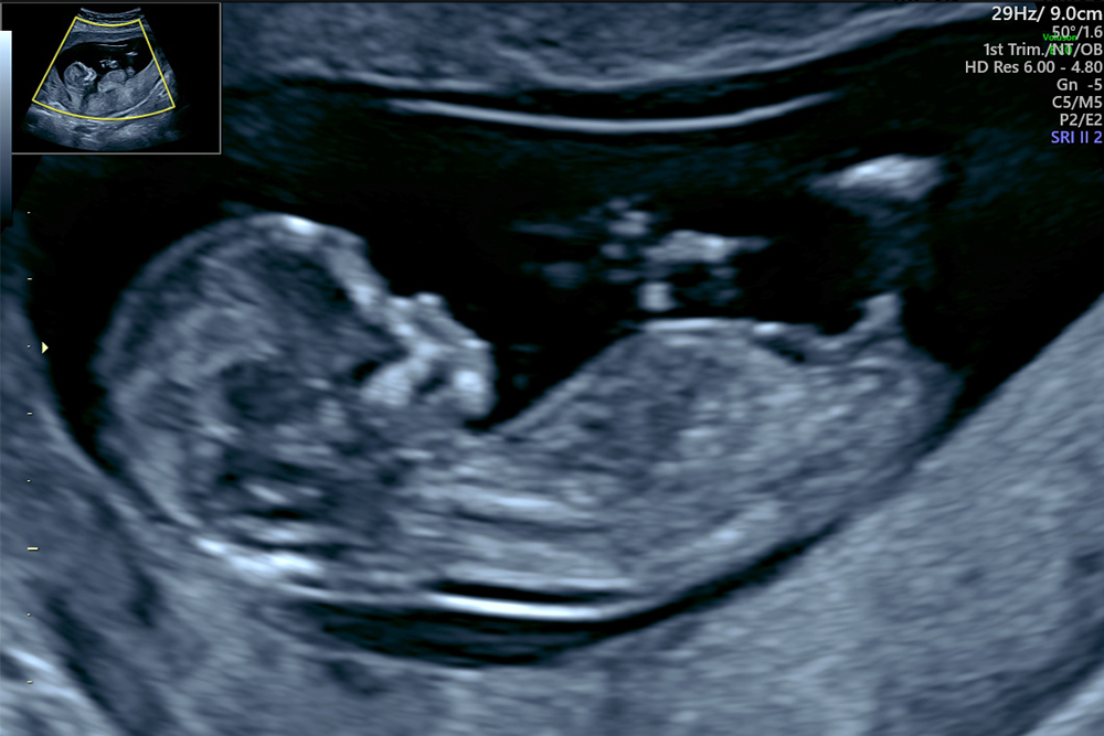 超音波検査の準備